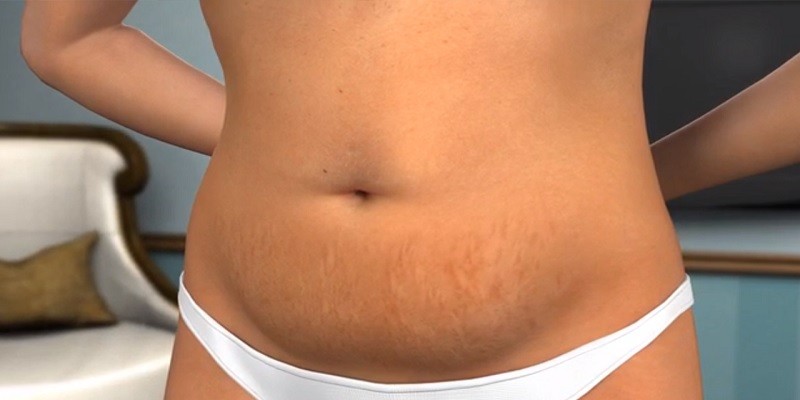 Can You Have A Baby After A Tummy Tuck