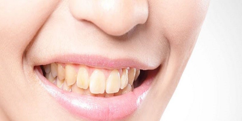 What Causes Yellow Teeth In A Teenager