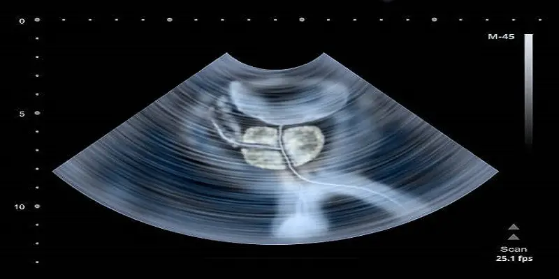 Can A Bladder Scanner Show Pregnancy