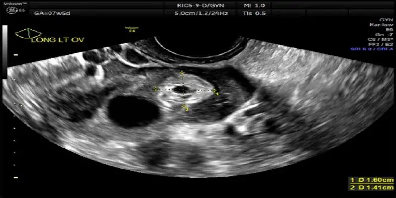 Can A Cyst Be Mistaken For Ectopic Pregnancy