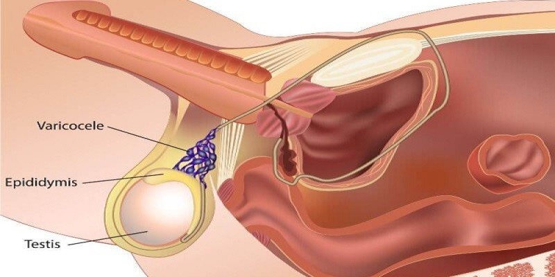 Can A Man With Varicocele Get A Woman Pregnant