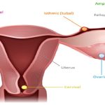Can Ectopic Pregnancy Be Misdiagnosed
