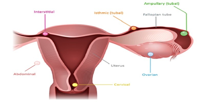 Can Ectopic Pregnancy Be Misdiagnosed