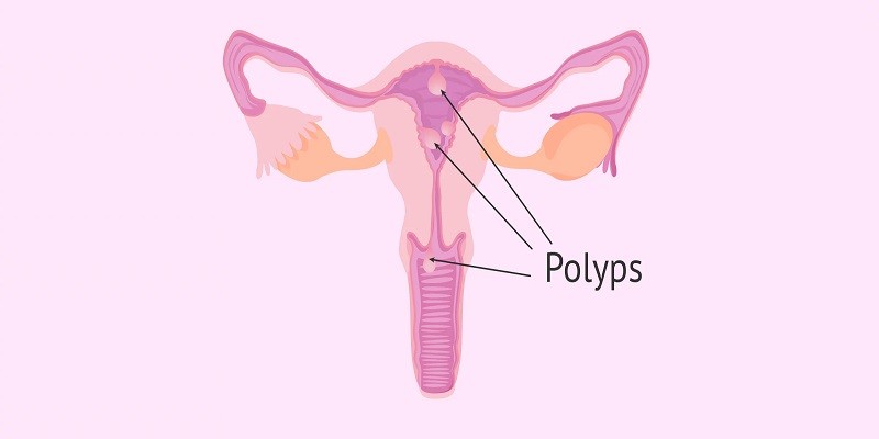 Can Cervical Polyps Prevent Pregnancy