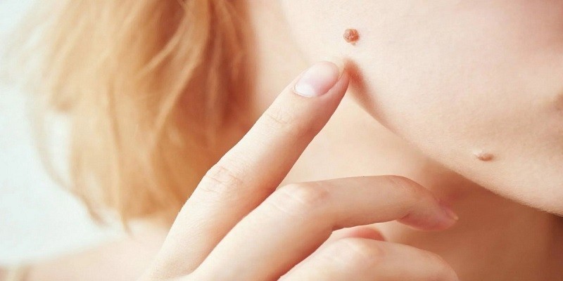 Can You Get A Mole Removed While Pregnant